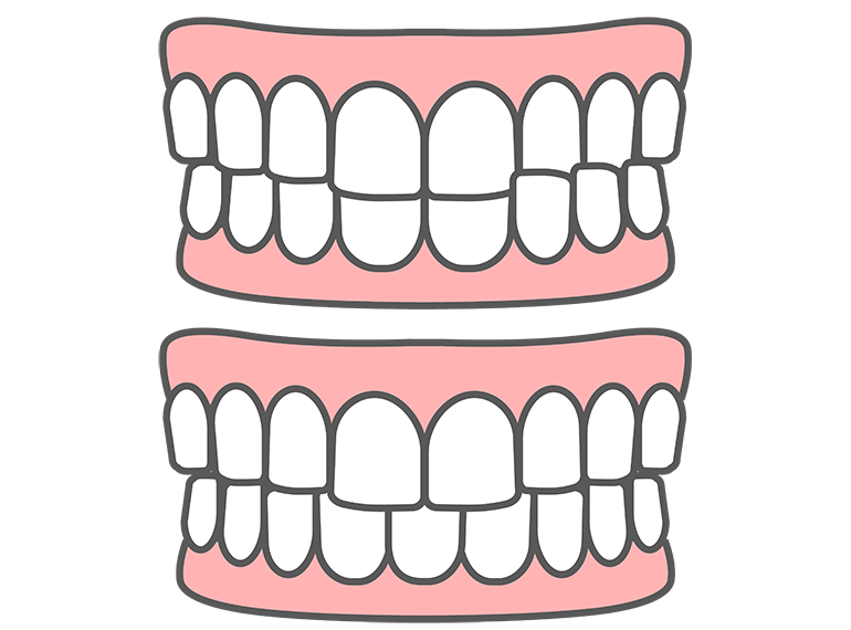 かみ合わせに乱れがある「交叉咬合（こうさこうごう）」